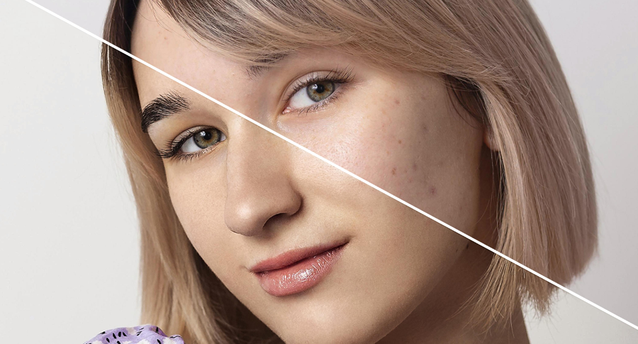 Tratamente pentru acnee, puncte negre și coșuri