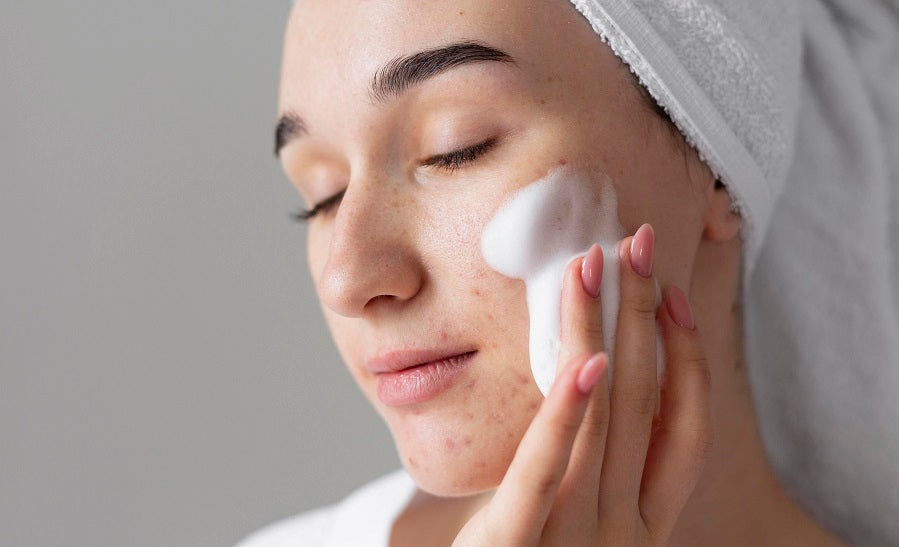 ACNEEA LA ADOLESCENȚI: SOLUȚII ȘI TRATAMENT